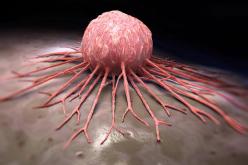 17 خطوة تبعد خطر السرطان