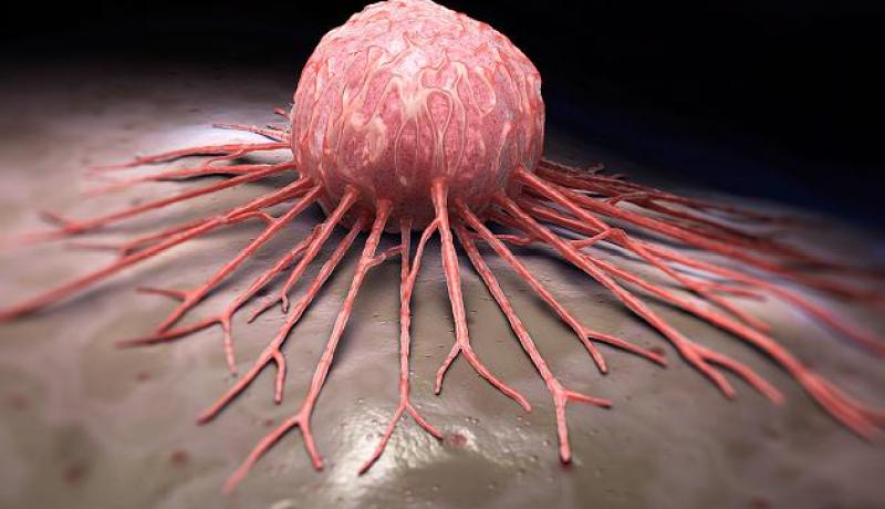 17 خطوة تبعد خطر السرطان