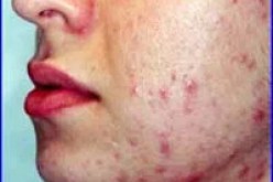 40 بالمائة من الجزائريين يعانون من حب الشباب