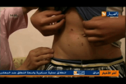 كلب مسعور يعتدي على 13 شخصا من بينهم طفلة في الـ4 من العمر