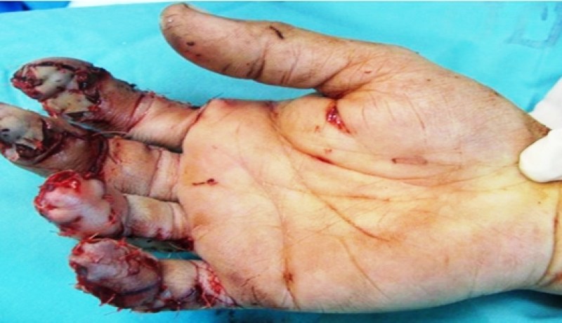 لصوص‮ ‬يبترون أصابع شاب ويطعنون شقيقه وسط مدينة وهران