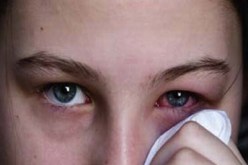 إحذروا ‬رمد الحساسية الملتهبة للعينين‮ ‬يعود