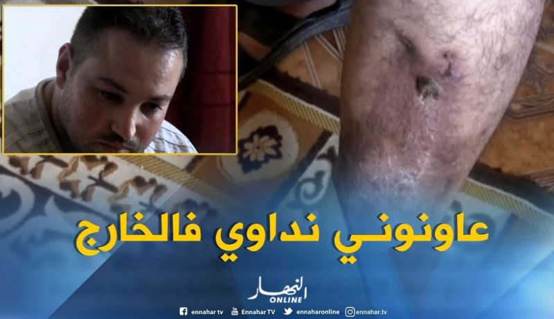 تيزي وزو/ ورم في الرجل يحول حياة “ياسين” إلى جحيم
