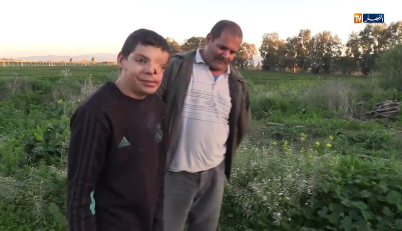 الطارف.. التشوه الخلقي يحول حياة الطفل صبري الى جحيم