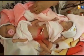 عائلة ترزق بتوأم ” سيامي “على مستوى البطن تناشد السلطات إنقاذهما !