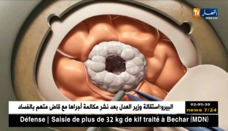 صحة: 200 إصابة بسرطان المخ عند الأطفال سنويا بالجزائر