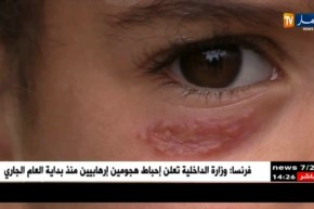 باتنة: مرض الليشمانيوز ينتشر ببلدية القصبات…