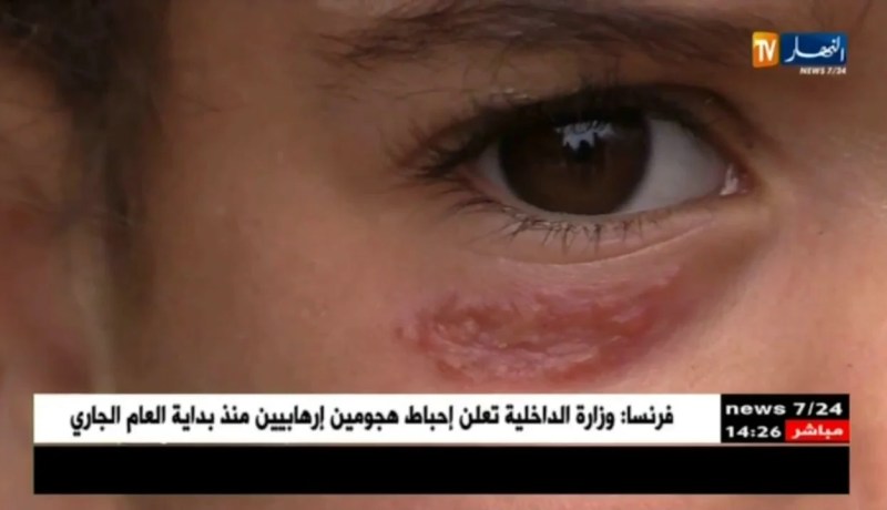 باتنة: مرض الليشمانيوز ينتشر ببلدية القصبات…