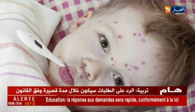 صحة ونصيحة: مرض الجدري..النظافة أساس العلاج