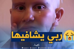 أم البواقي: داء الثعلبة يفقد الطفلة أشواق شعر رأسها وحاجبيها ورموش عينيها