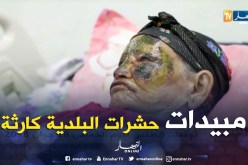 الأغواط: إصابة إمرأة وطفل بتشوهات وحروق بسبب رش البلدية لمبيدات الحشرات