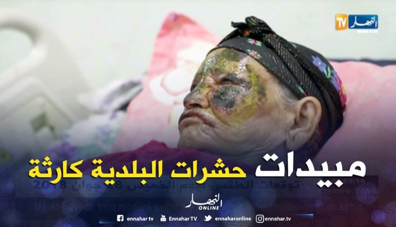 الأغواط: إصابة إمرأة وطفل بتشوهات وحروق بسبب رش البلدية لمبيدات الحشرات