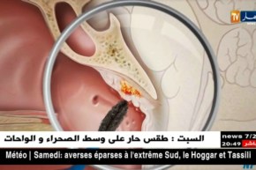 صحة: تسجيل 1500 حالة جديدة بسرطان الكافوم والبلعوم بالجزائر