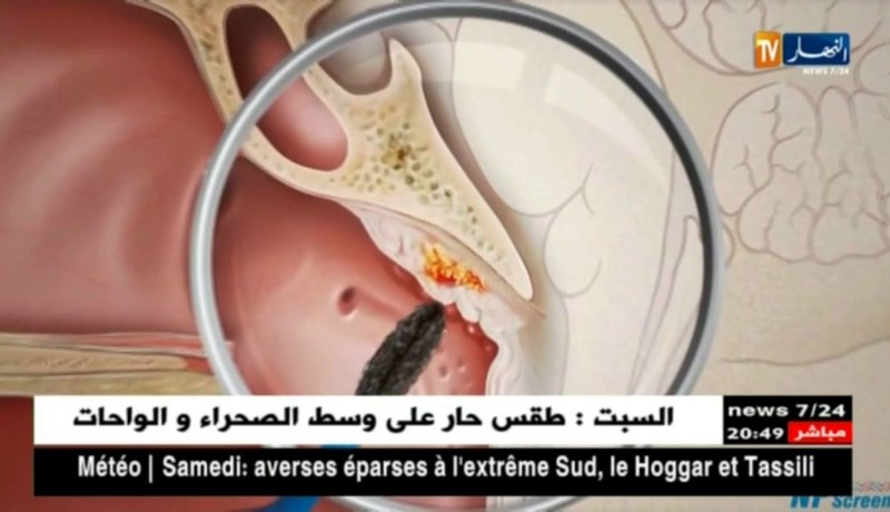 صحة: تسجيل 1500 حالة جديدة بسرطان الكافوم والبلعوم بالجزائر