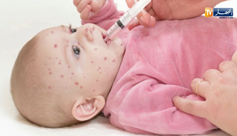 صحة: الوصاية تسجل أزيد من 300 إصابة بالحصبة الألمانية