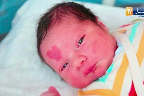 حقيقة “الوحمة” التي قد تظهر على جسم الطفل الصغير