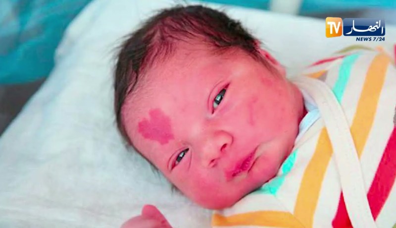 حقيقة “الوحمة” التي قد تظهر على جسم الطفل الصغير