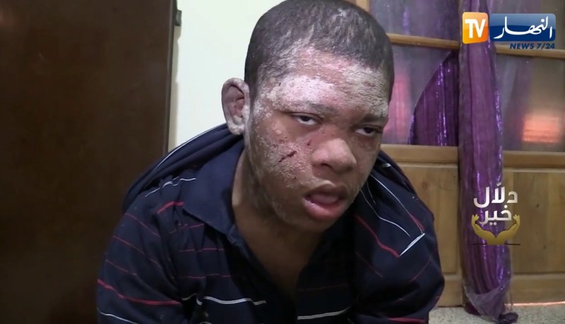 دلال خير: طفل من الوادي مصاب بمرض نادر أكل جسده وجلدة والأطباء لم يشخصوا حالته