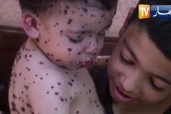 مرض نادر ينخر جسد الرضيع أنس وغياب الدواء زاد من المعاناة