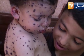 مرض نادر ينخر جسد الرضيع أنس وغياب الدواء زاد من المعاناة