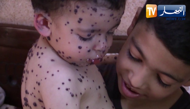 مرض نادر ينخر جسد الرضيع أنس وغياب الدواء زاد من المعاناة