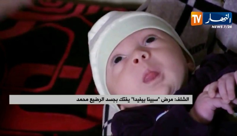 الشلف : مرض ” سبينا بيفيدا” يفتك بجسد الرضيع محمد