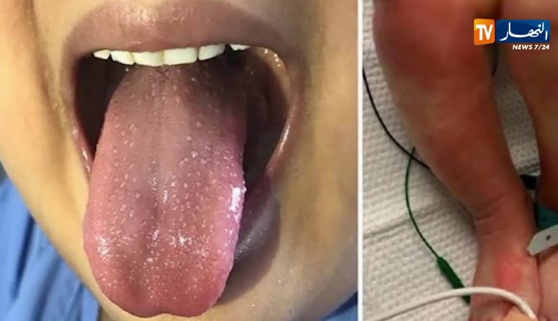 بعد تسجيل أول إصابة بالجزائر.. هذا هو مرض الكاوازاكي وهذه أغراضه