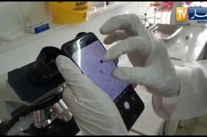 “شاهد..إختبار لعينة من قطرة دم لمصابة بوباء “الملاريا