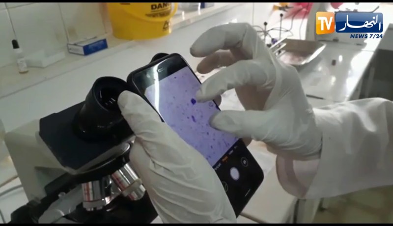 “شاهد..إختبار لعينة من قطرة دم لمصابة بوباء “الملاريا