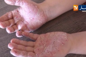 تيزي وزو/ إنشاء مدرسة للتربية الصحية لفائدة مرضى الإكزيما