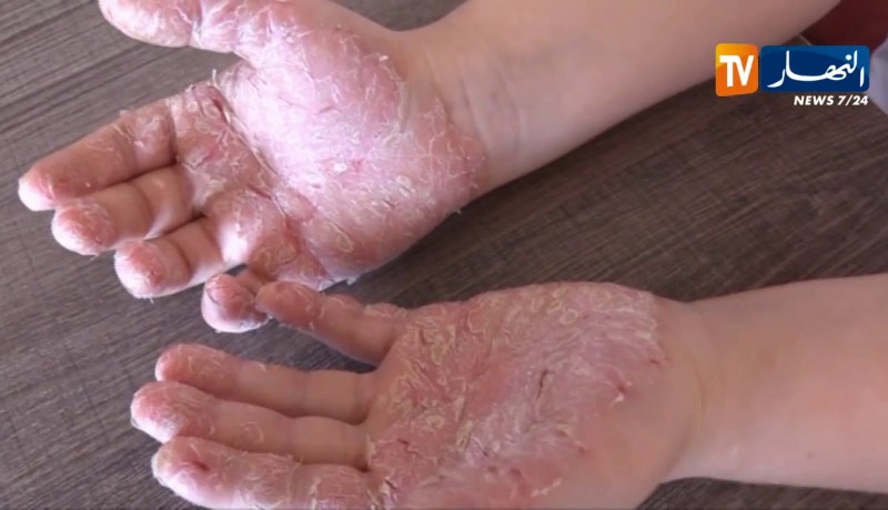 تيزي وزو/ إنشاء مدرسة للتربية الصحية لفائدة مرضى الإكزيما