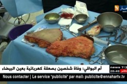 صحة: عمليات تجميلية لشفط الدهون تستهوي بعض الجزائريين