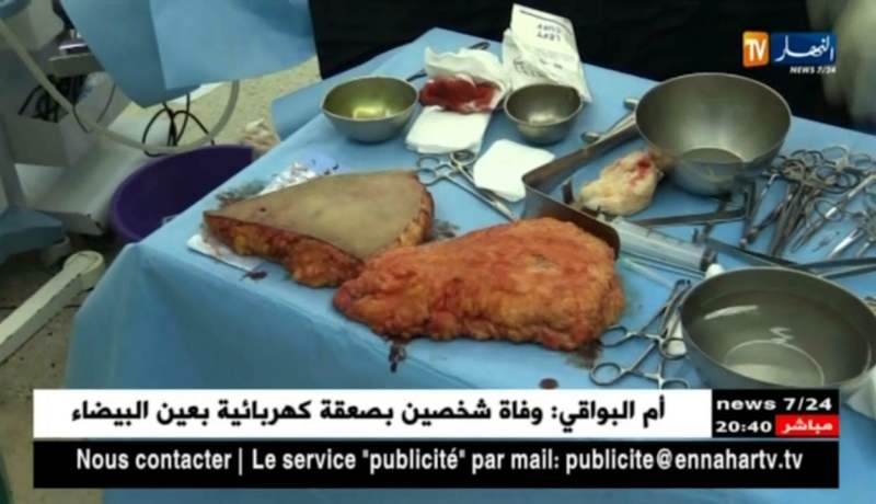 صحة: عمليات تجميلية لشفط الدهون تستهوي بعض الجزائريين