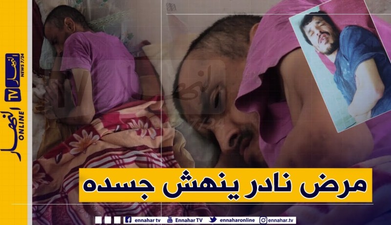 دلال خير: نسيم شاب في الثلاثينات نهش مرض غريب لحمه وجلده ووالده يتعذب معه