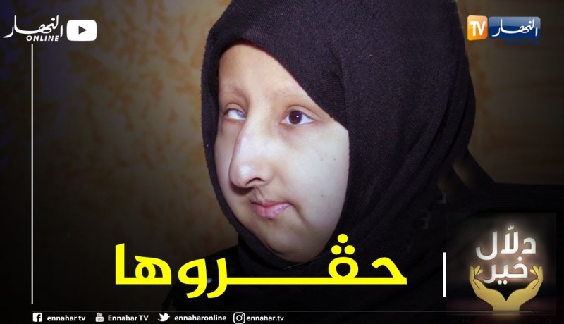 دلال خير: مراهقة ولدت بتشوهات خلقية وسط مجتمع لا يرحم جعلها حبيسة المنزل وأثر عليها نفسيا