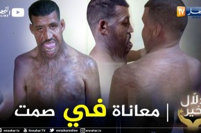 دلال خير: يوسف.. تعرض لحروق خطيرة أعجزته عن النطق ينتظر من المحسنين التكفل بحالته ليستعيد عافيته