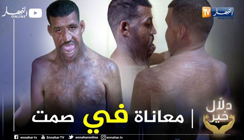 دلال خير: يوسف.. تعرض لحروق خطيرة أعجزته عن النطق ينتظر من المحسنين التكفل بحالته ليستعيد عافيته