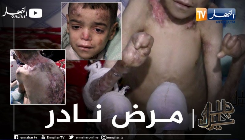 دلال خير: طفل يتألم كل يوم كأنه إحترق والأطباء لم يشخصوا مرضه بعد.. عائلته تناشد المحسنين لمساعدته