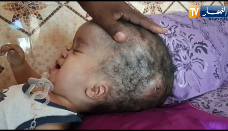 المغير: البراءة عبد الله سنة من المعاناة يناشد السلطات بالتكفل الصحي