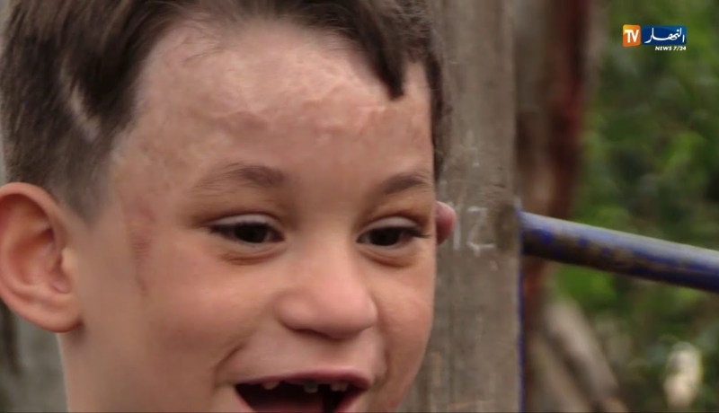 مجتمع: إسلام.. ملاك مشوه ينتظر إلتفاتة المحسنين