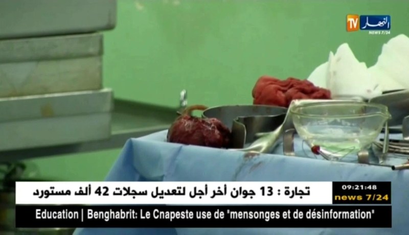 بسكرة/ 60 عملية جراحية نوعية في الأيام الطبية الجراحية