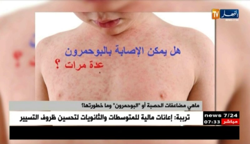 64 حالة بولاية إيليزي …تسجيل حالات الحصبة في الجزائر بعد سنوات من الغياب !