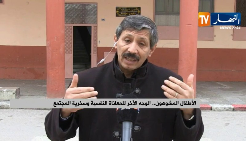 الأطفال المشوهون…الوجه الآخر للمعاناة النفسية وسخرية المجتمع