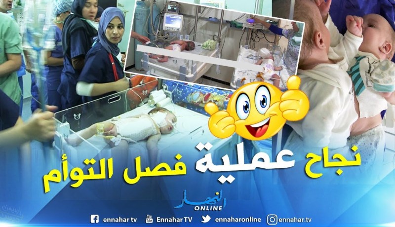 صحة: عملية جراحية دقيقة لفصل رضيعين توأم..تكلل بالنجاح