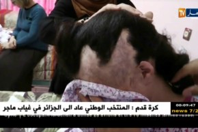 صحة: عملية تجعيد الجلد.. تقنية تعيد الشعر بعد فقدانه