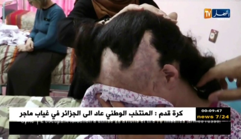 صحة: عملية تجعيد الجلد.. تقنية تعيد الشعر بعد فقدانه