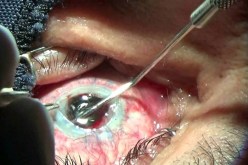 تقنية جديدة لزراعة قرنية العين بوهران