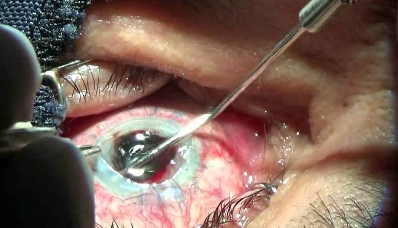 تقنية جديدة لزراعة قرنية العين بوهران