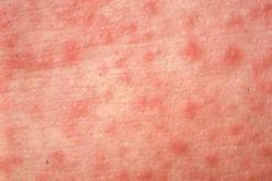 باحثون أمريكيون يكتشفون لقاحا للحصبة يستنشق عن طريق الفم