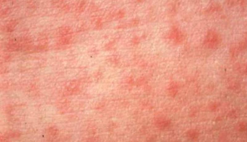 باحثون أمريكيون يكتشفون لقاحا للحصبة يستنشق عن طريق الفم